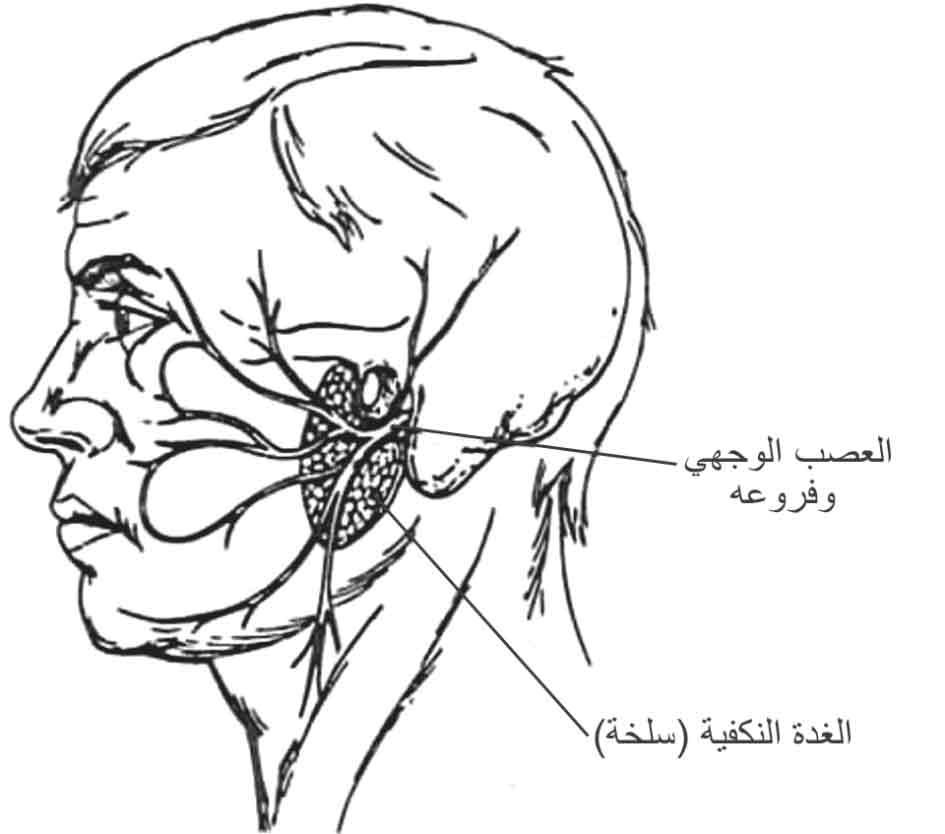 موقع العصب الوجهي بعد استئصال الفص السطحي للغدة النكفية ويظهر الفص العميق